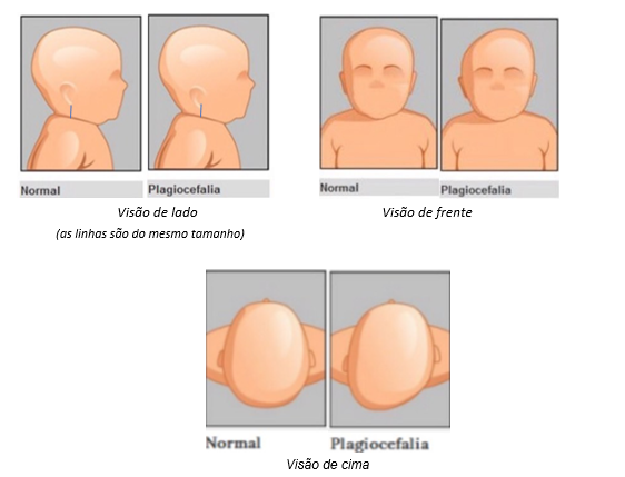 O que é a Craniossinostose ou Cranioestenose? - Blog São Lucas Hospital