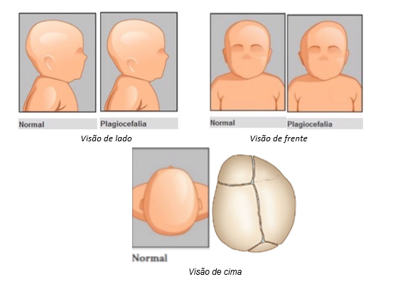 O que é a Craniossinostose ou Cranioestenose? - Blog São Lucas Hospital